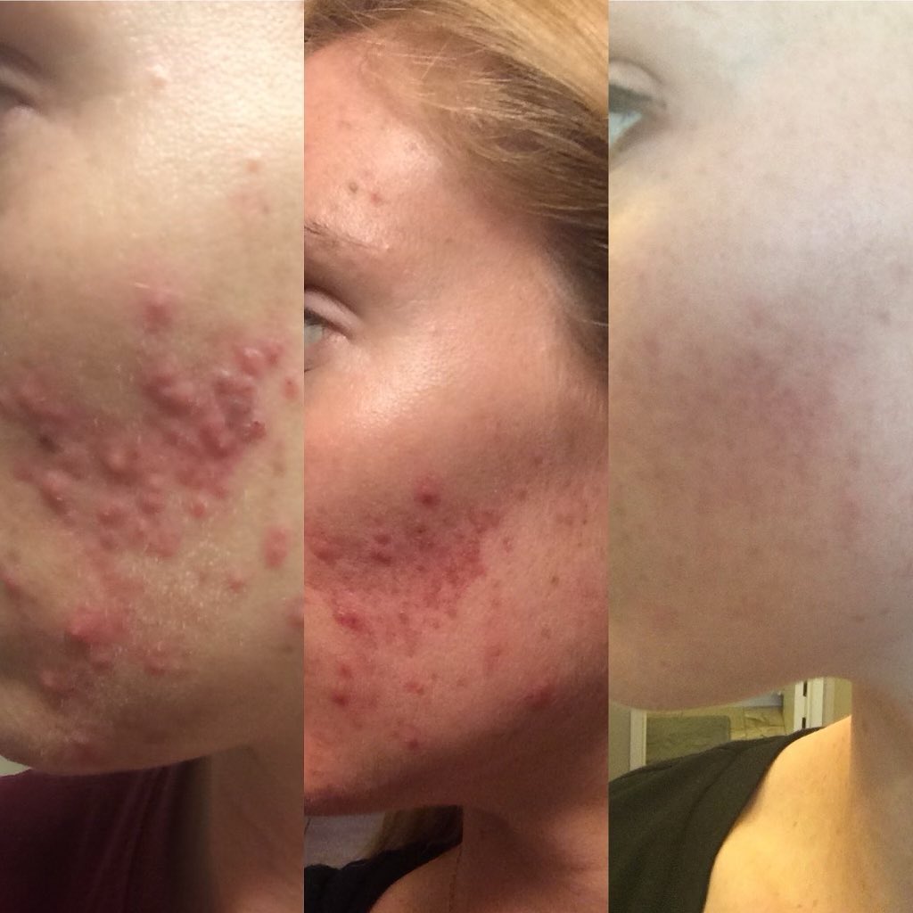 MINDBODYSKIN - Hormonal Acne Supplement