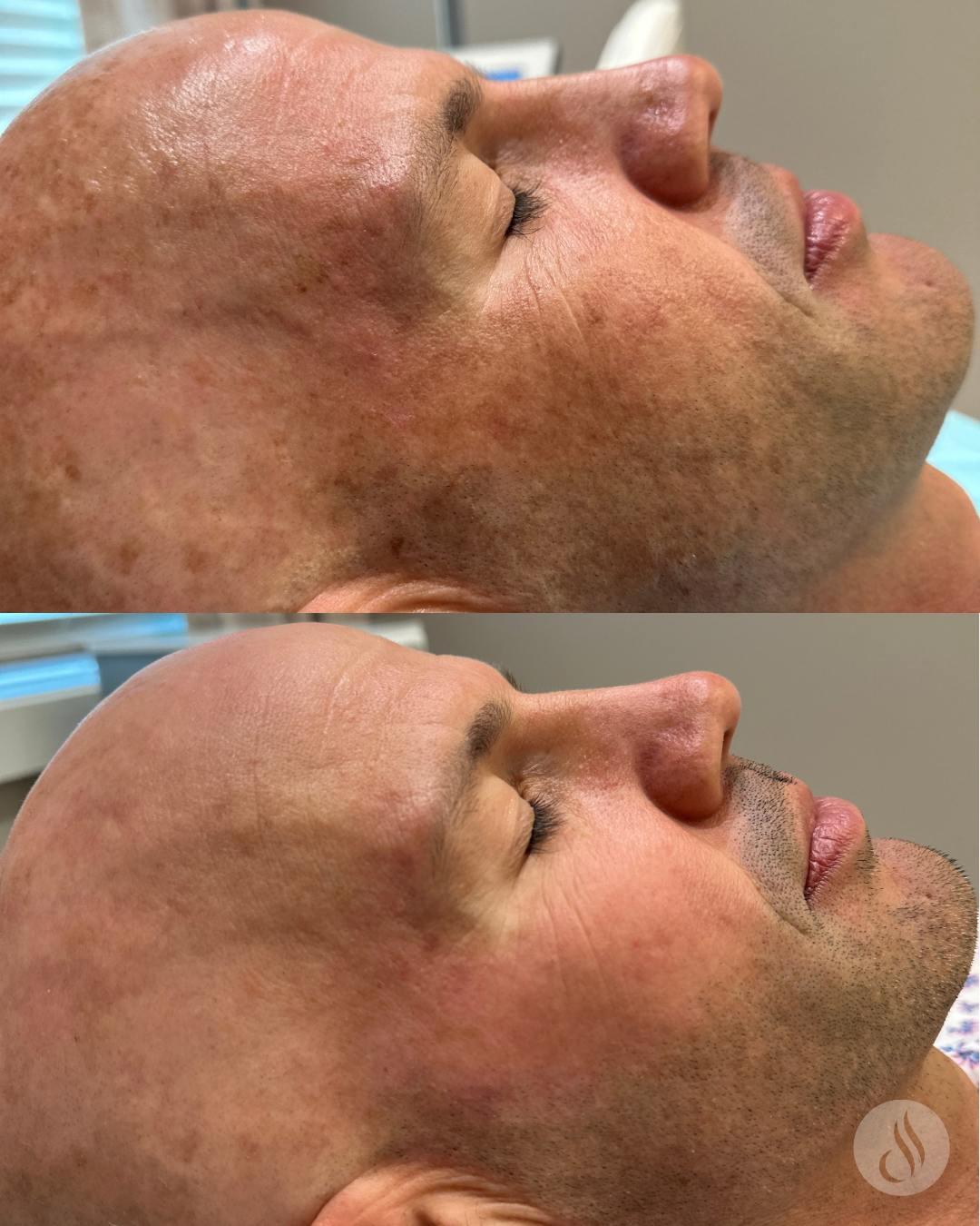 BBL Moxi Combo Treatment - Face & Neck
