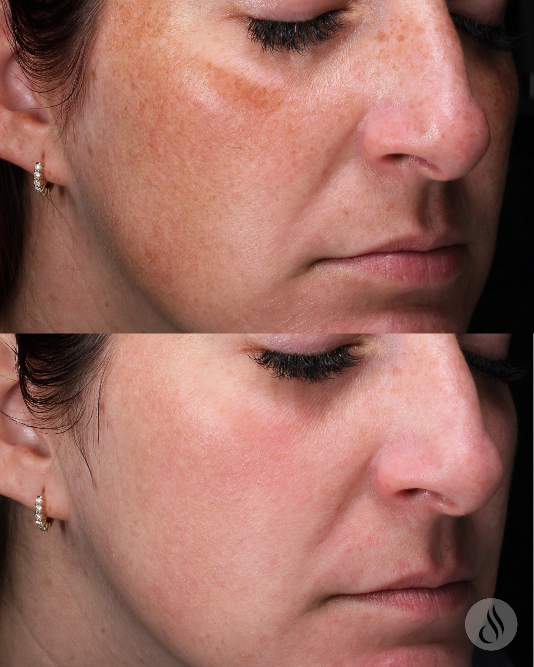 BBL Moxi Combo Treatment - Face & Neck