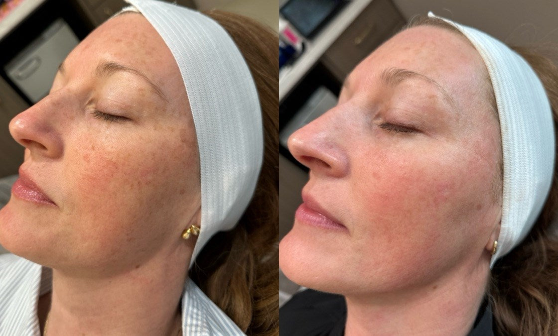 BBL Moxi Combo Treatment - Face & Neck