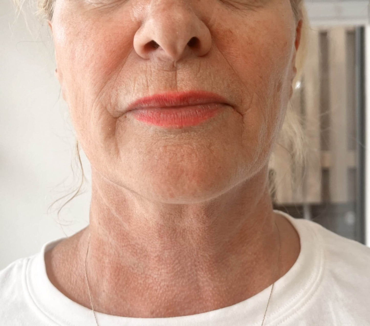 Sofwave + Tox' Bundle