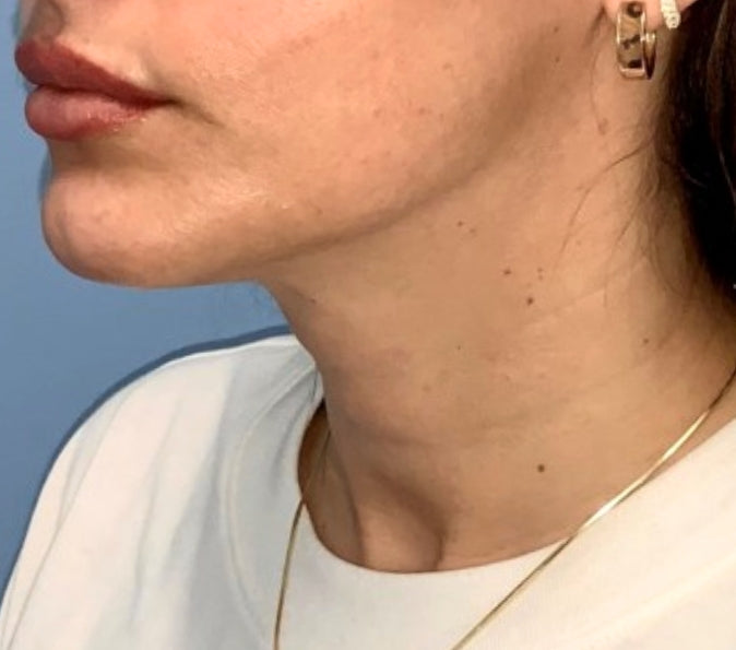 Sofwave + Tox' Bundle