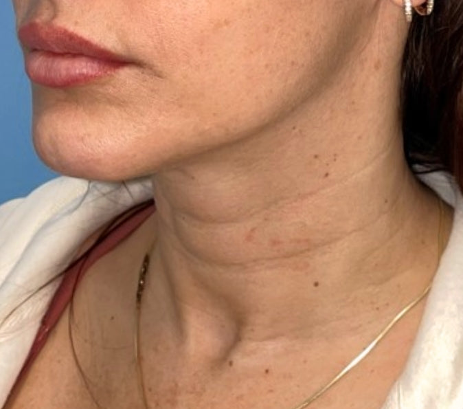 Sofwave + Tox' Bundle