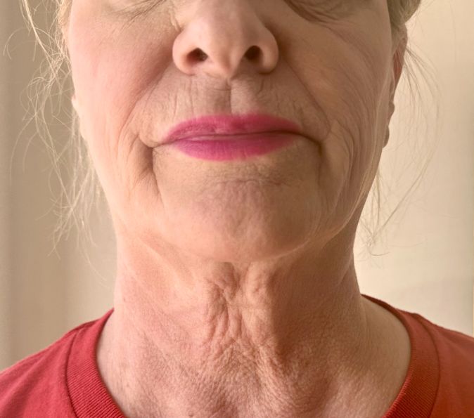 Sofwave + Tox' Bundle